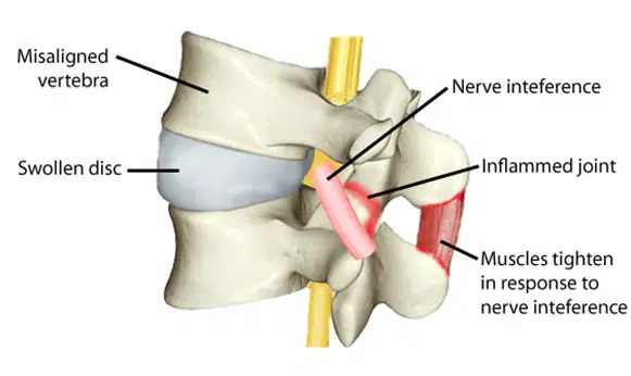 what-is-subluxation-matthews